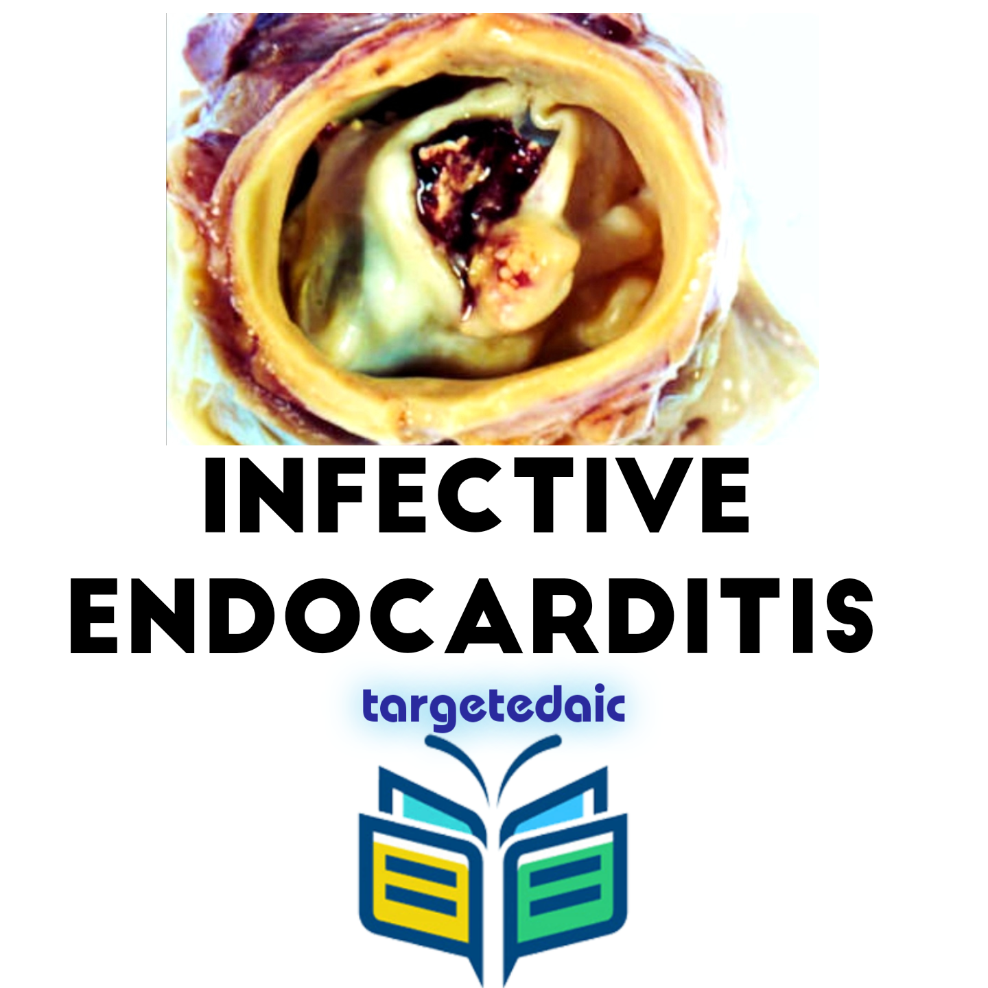 2021-06-09T22_27_31.467022cute_photo infective endocarditis