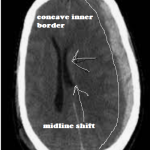 SDH CT PICTURE