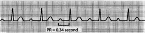 first degree heart block